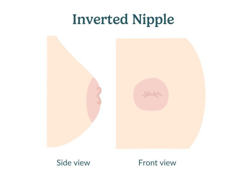 Inverted Nipple Menghambat Ibu Menyusui, Benarkah?
