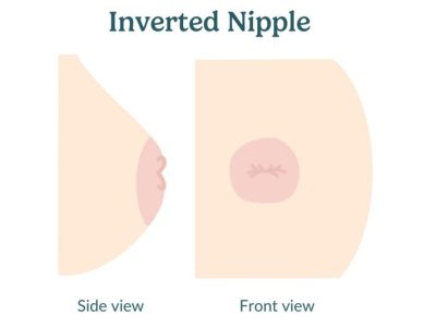 Inverted Nipple Menghambat Ibu Menyusui, Benarkah?