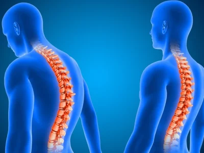 Kelainan Pada Tulang Seseorang Atau Kifosis
