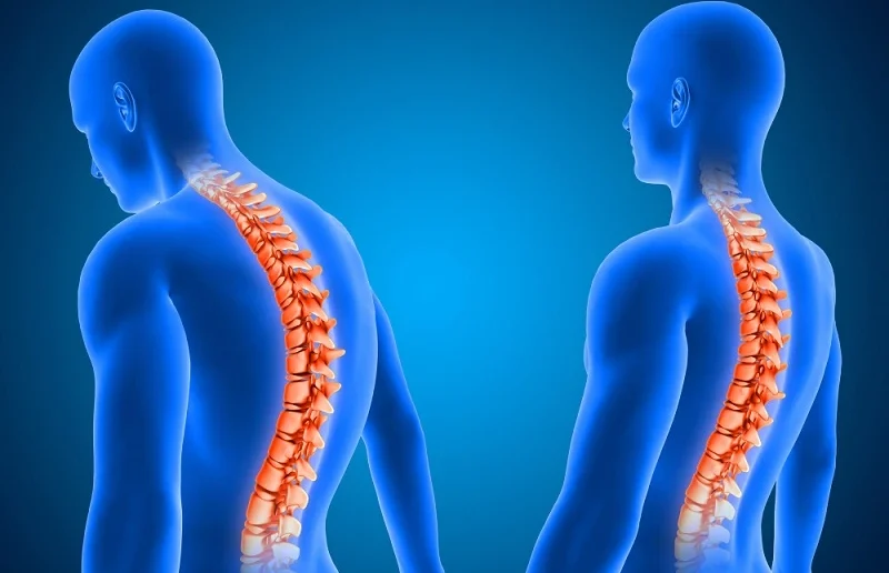 Kelainan Pada Tulang Seseorang Atau Kifosis