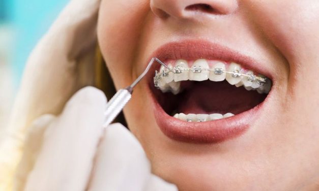 Pemakaian Behel Di Kalangan Anak Muda